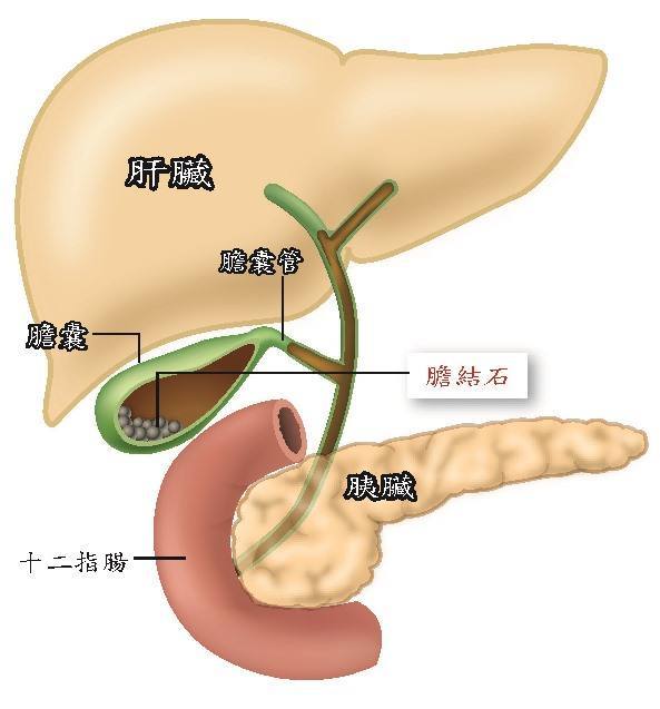 天津市三中心医院胆结石