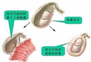 “胆结石”都会对身体造成怎样的伤害?