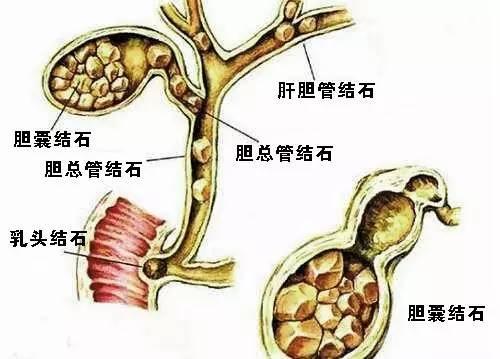 科普 | 胆结石中“沉默的杀手”最恐怖!--一位肿瘤医生的肺腑之言