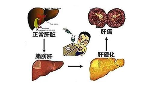 肝胆相照,肝友应谨防肝病又添胆结石,教你如何养肝胆