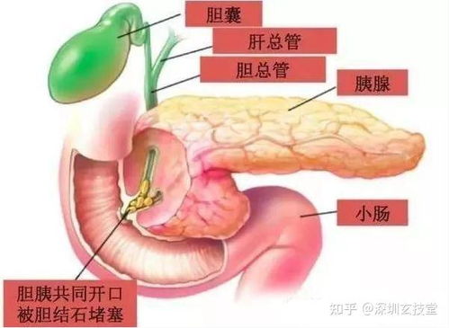胆总管结石如何治疗