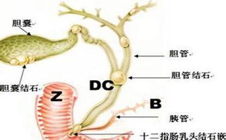 胆结石成因