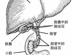 胆结石最佳治疗方法