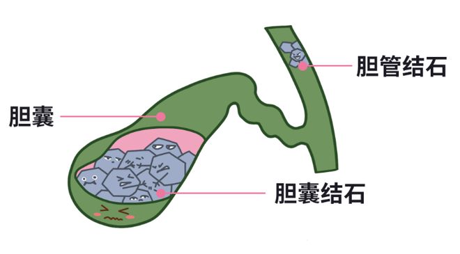 胆结石患者能否购买百万医疗险？最宽松的产品推荐在这里！