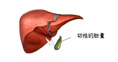 14岁女孩反复腹痛，竟是胆结石惹的祸