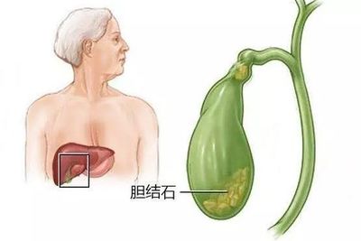 胖子们,你们的胆结石发病率是常人的5倍!