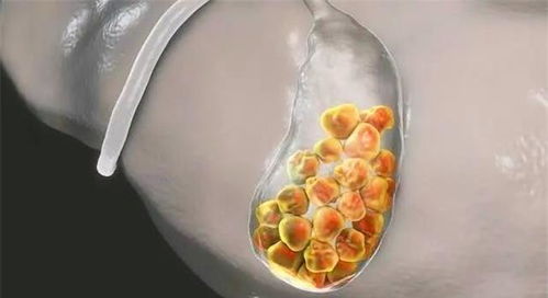 肾结石患者如何正确喝水 专家解读方法，兼谈胆结石注意事项