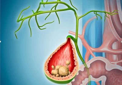胆结石无症状的发现与科学应对策略