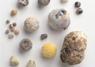 我为什么会得结石？看完恍然大悟——胆结石