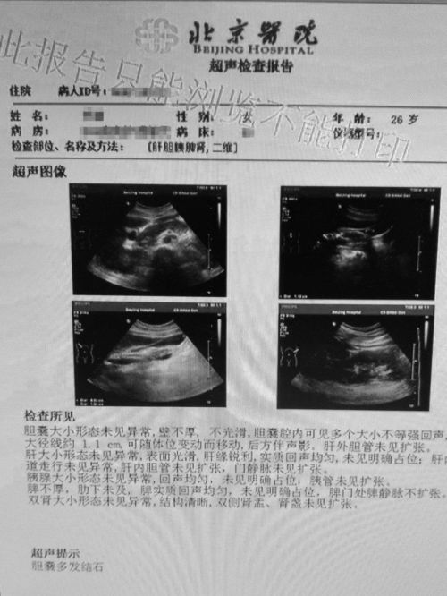 年轻胆结石患者的新选择 除了切除胆囊还有哪些更优方案？