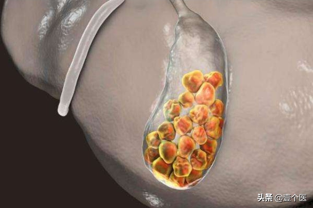 如何有效排出胆结石 方法、预防与注意事项