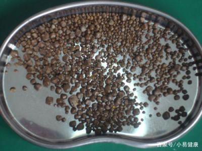 胆结石最偏爱的人 这六类高发人群，你在其中吗？