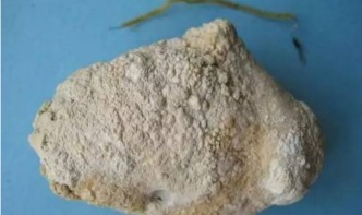 胆结石治疗的常见方法