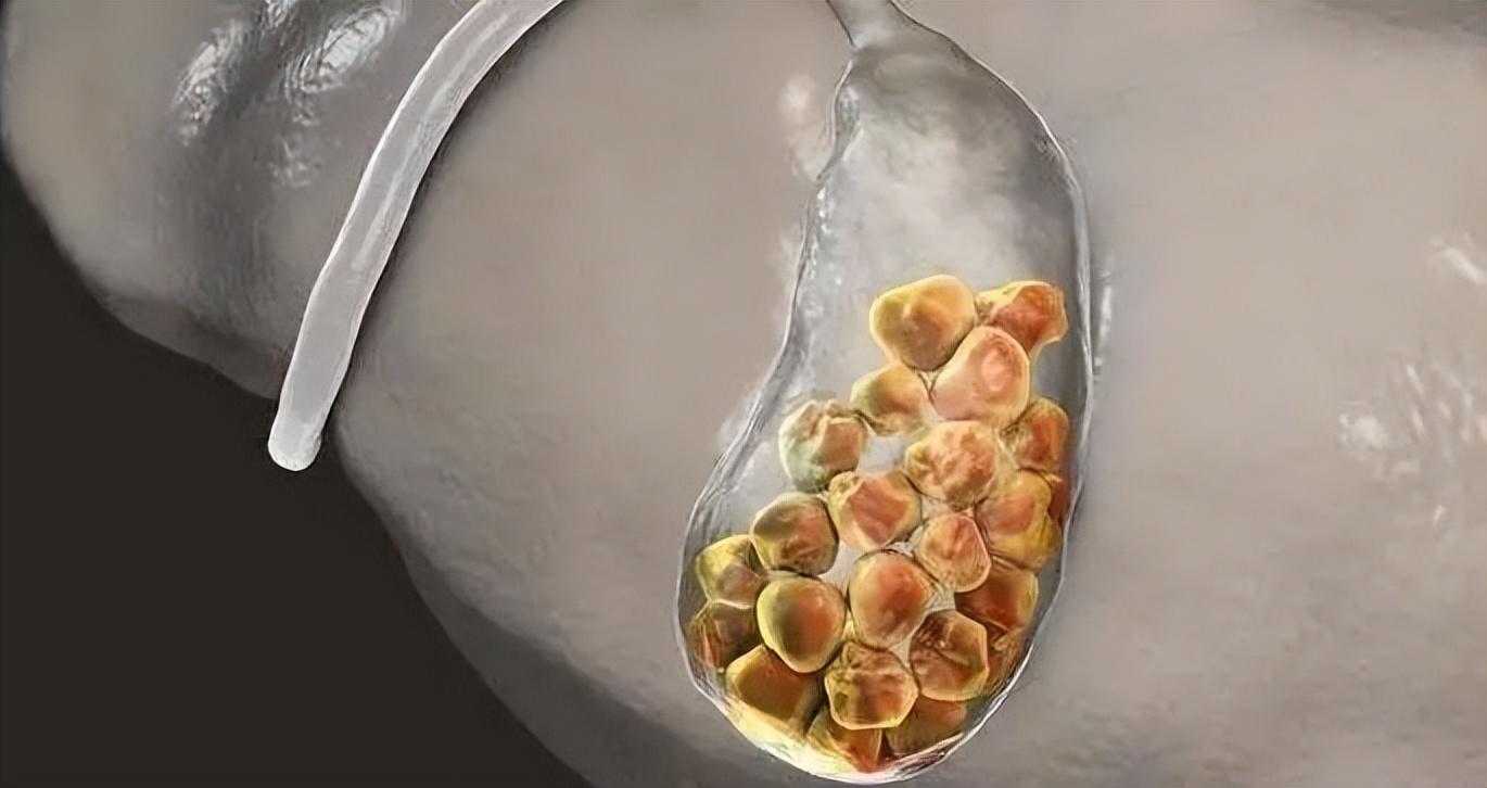 不要被结石“吓破胆”！教你看懂胆结石