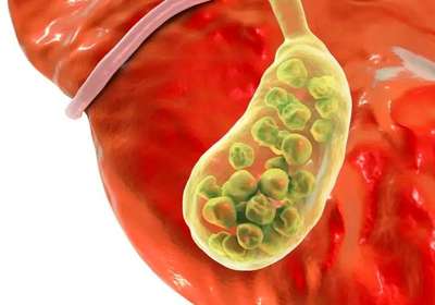DNA超分子技术引领结石治疗新方向——PDNAXI肝胆宝的科学探索