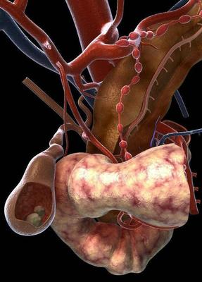 胆结石患者指南 别轻信“吃某种营养品能打碎石头”的误区