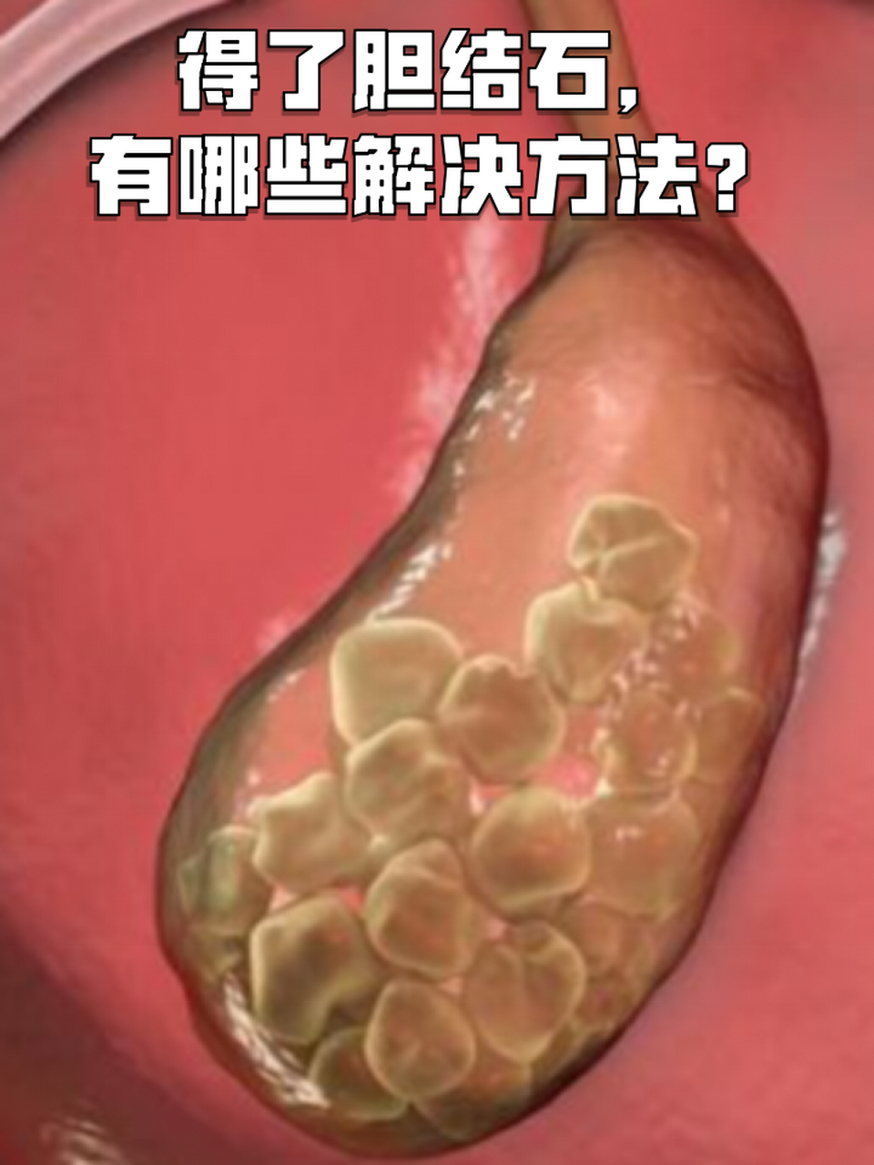 胆结石 这种常见的“隐形威胁”你了解吗？