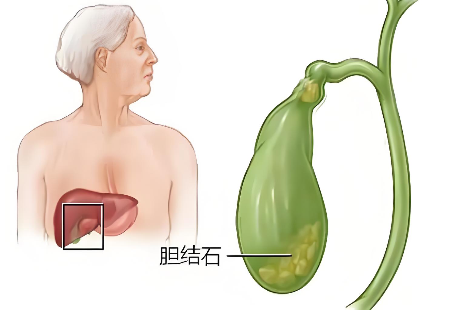 为什么说胆结石就是阳气不足了呢