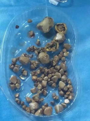 胆结石有哪些最佳治疗方法?