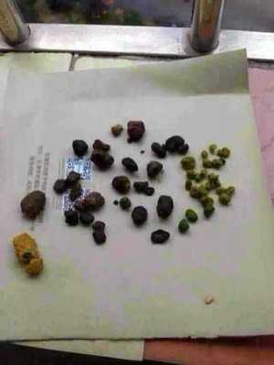 胆结石 成因、症状与防治指南