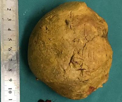 直径十厘米、重达三百克的“巨石”，医生手术室内见证医学罕见奇观