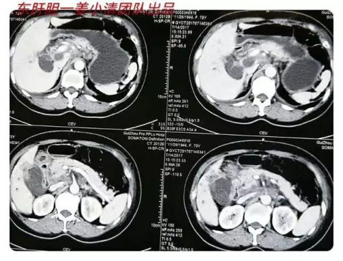 沉默的杀手 一位肿瘤医生的肺腑之言，重新审视胆结石的致命风险